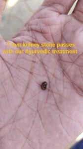 7 mm Kidney stone passes with our Ayurvedic treatment