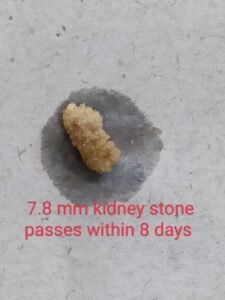 7.8 mm Kidney Stone Cleared in Just 8 Days with Ayurvedic Treatment – No Surgery Required