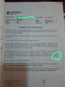 Kidney stone of 8.4mm passed within 4 days