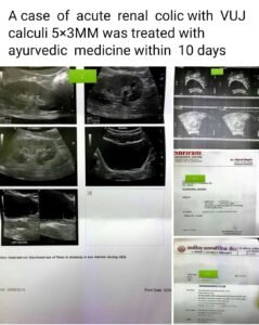 kidney stone cures in 10 days