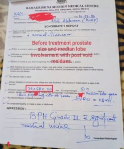 No Surgery Needed! Prostate Enlargement Successfully Treated with Ayurveda