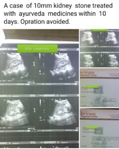 A case of 10mm kidney streated with ayurveda medicines within 10 days. Opration avoided.
