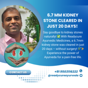 6.7 mm Kidney Stone Cleared in Just 20 Days with Ayurvedic Treatment – No Surgery Required