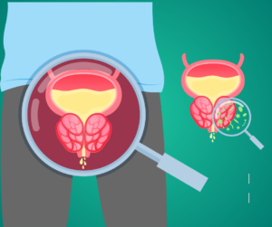 Understanding Prostate Enlargement: Ayurvedic Solutions for Effective Management