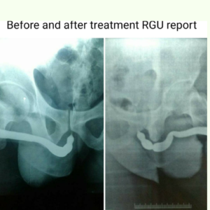 Faster Relief in Urethral Stricture | Visible Progress in 8–10 Days – Readycure Ayurveda